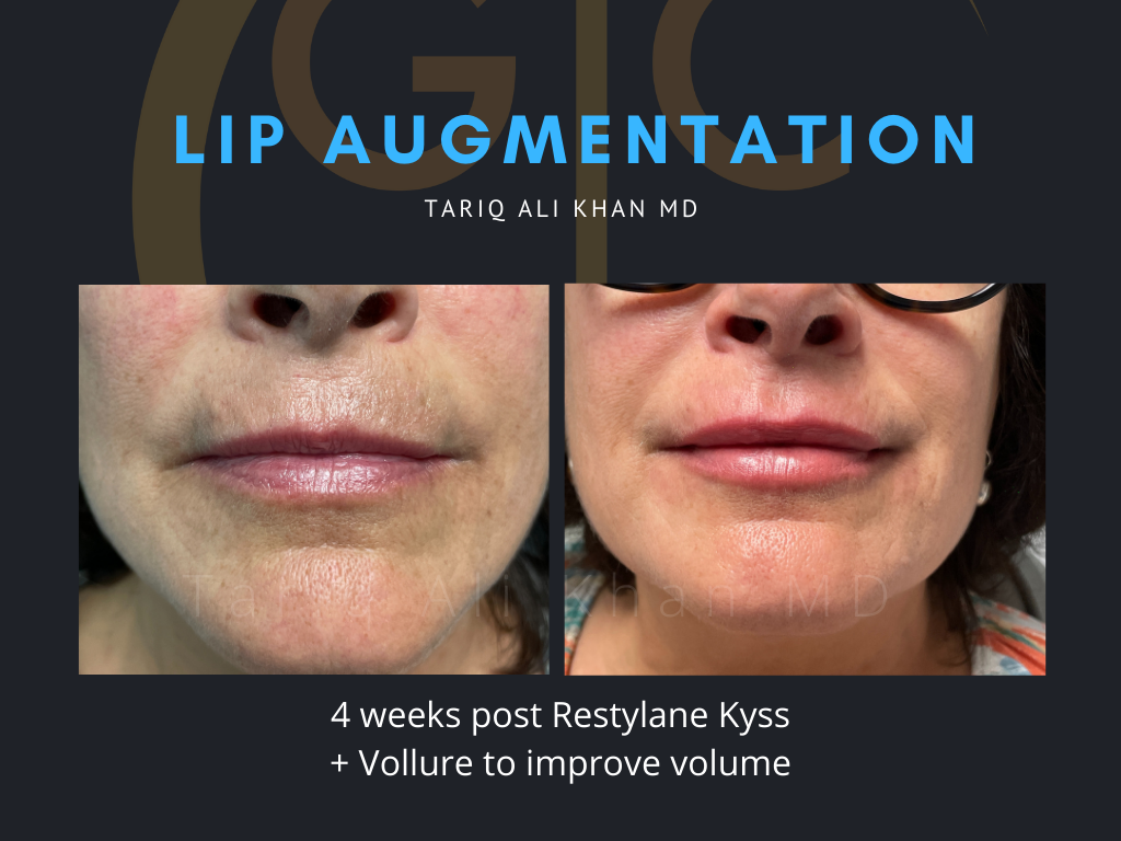 Gentle Care Laser Tustin & Long Beach Before and After picture - Lip Augmentation